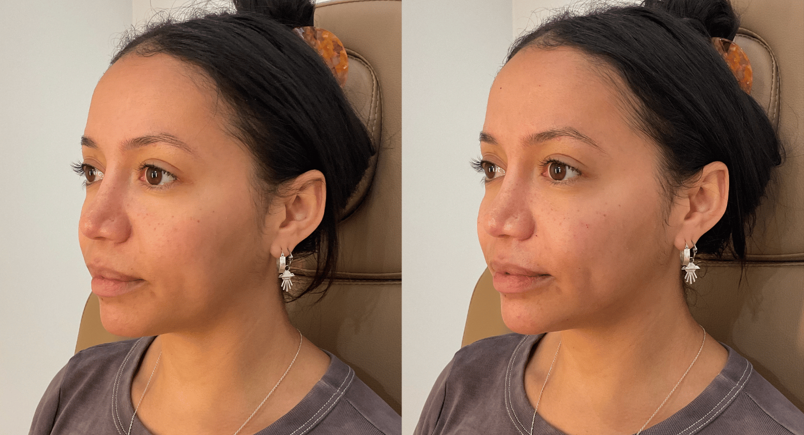 DermalFiller_CheeksandChin